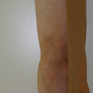 Comparison between ProsthStyle Prosthetic Cover and perlon cosmetic stocking